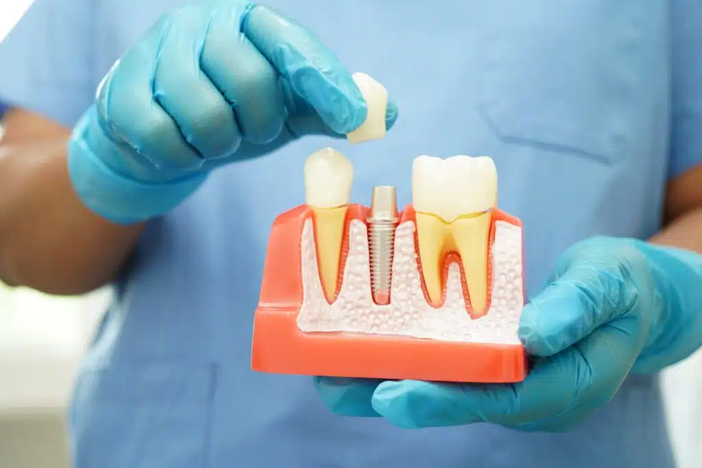 Root Canals Neenah