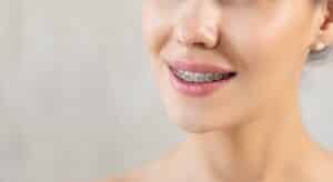 Traditional Braces in Neenah Explained