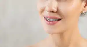 Traditional Braces in Neenah Explained